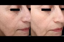 Pico Laser Treatment