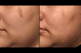 Picosure Laser Treatment in Dubai