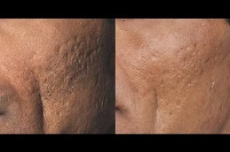 Picosure Laser Treatment Dubai