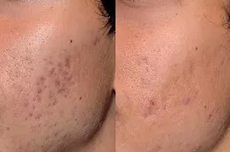Picosure Laser Treatment
