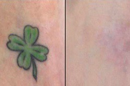 Picosure Tattoo Removal Abu Dhabi