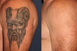 Picosure Tattoo Removal Clinic Abu dhabi