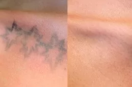 Picosure Tattoo Removal Dubai