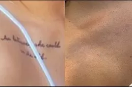 Picosure Tattoo Removal in Abu Dhabi