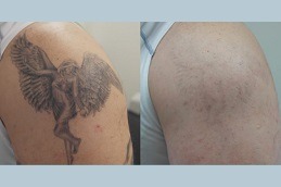 Picosure Tattoo Removal in Dubai