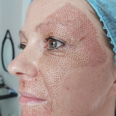 Plasma Pen Treatment in Dubai, Abu Dhabi & Sharjah Plasma Pen Price
