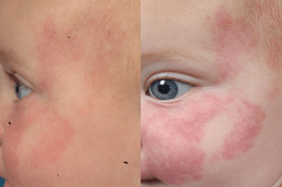 Port Wine Stains Clinic in Abu Dhabi