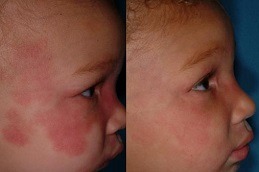 Port Wine Stains Clinic in Dubai