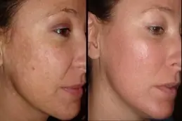 Radio Frequency for Acne Scars Clinic Dubai