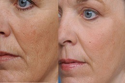 Radio Frequency for Acne Scars Clinic in Abu Dhabi