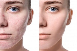 Radio Frequency for Acne Scars