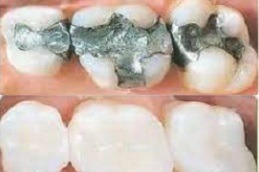 Best Root Canal Treatment in Dubai 