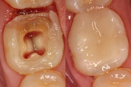 Root Canal Treatment Dubai