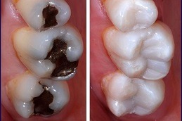 Root Canal Dubai 