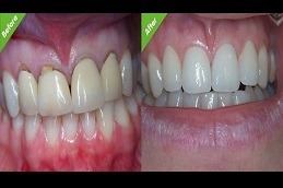 Root Canal Treatment Dubai