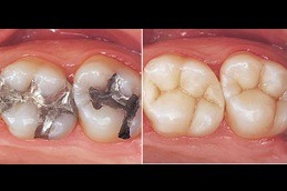 Root Canal Treatment