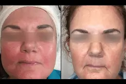 Rosacea Treatment Clinic in Dubai
