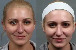 Rosacea Treatment Dubai & Abu Dhabi