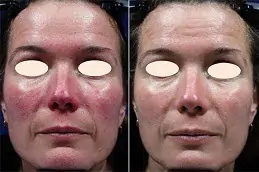 Rosacea Treatment in Dubai & Abu Dhabi