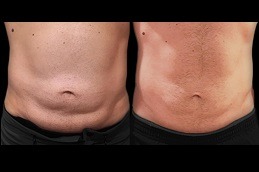 SculpSure Body Contouring Clinic in Abu Dhabi