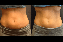SculpSure Body Contouring Clinic in Dubai