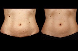 SculpSure Body Contouring Dubai