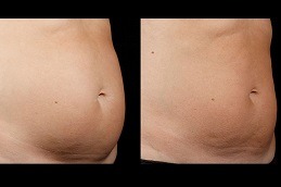 SculpSure Body Contouring in Abu Dhabi