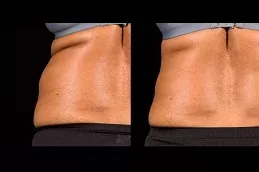 SculpSure Body Contouring in Dubai