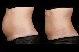 SculpSure Body Contouring