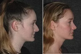 Silicone Nose Surgery Clinic in Abu Dhabi