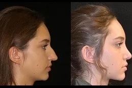 Silicone Nose Surgery Clinic in Dubai