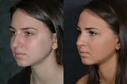 Silicone Nose Surgery Dubai & Abu Dhabi