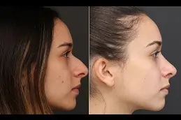 Silicone Nose Surgery in Abu Dhabi