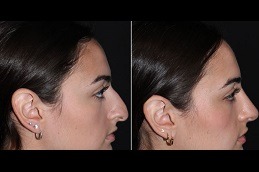 Silicone Nose Surgery in Dubai