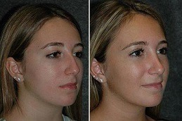 Silicone Nose Surgery
