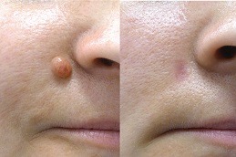 Skin Lesion Removal Clinic in Abu Dhabi