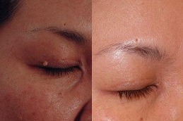 Skin Lesion Removal Clinic in Dubai