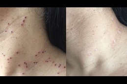 Skin Lesion Removal Dubai