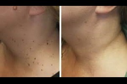 Skin Lesion Removal in Abu Dhabi