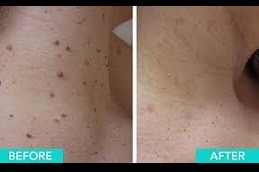 Skin Lesion Removal in Dubai
