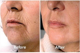 Skin Toning Treatment Abu Dhabi