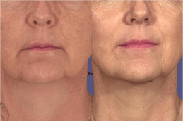 Skin Toning Treatment Clinic Dubai