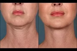 Skin Toning Treatment Dubai & Abu Dhabi