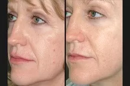 Skin Toning Treatment in Dubai & Abu Dhabi