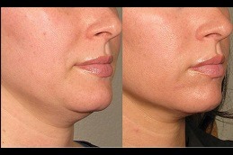 Skin Toning Treatment in Dubai