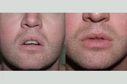 Smoker’s Lips Treatment Abu Dhabi