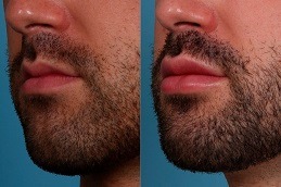 Smoker’s Lips Treatment in Abu Dhabi