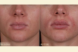 Smoker’s Lips Treatment