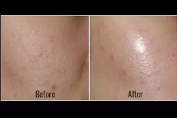 Spectra Laser Carbon Peel Clinic in Abu Dhabi