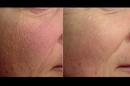 Spectra Laser Carbon Peel Clinic in Dubai